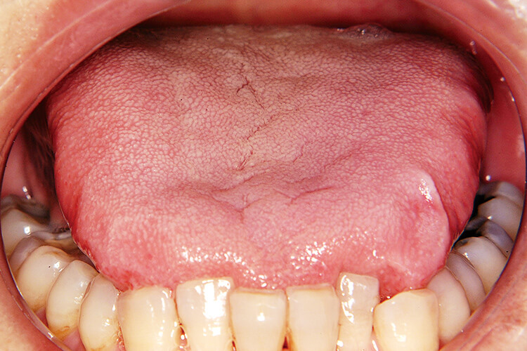 歯列に一致した舌表面の圧痕。