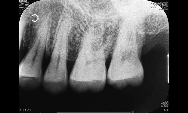 咬合痛を訴えた左側上顎臼歯部のデンタルX線写真。小臼歯部の明瞭な歯槽硬線を認める。