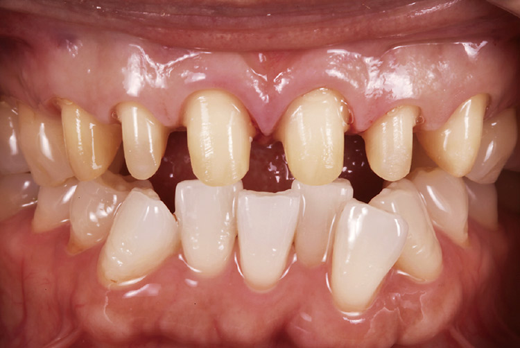 図7　支台歯形成後。本症例の支台歯は生活歯であった。歯髄の保存を考慮し、必要最低限のクリアランスで支台歯形成を行った。