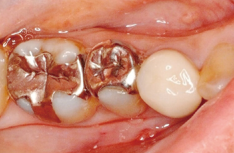 右側下顎臼歯部（第二小臼歯・第一大臼歯）の審美障害で当院を受診。