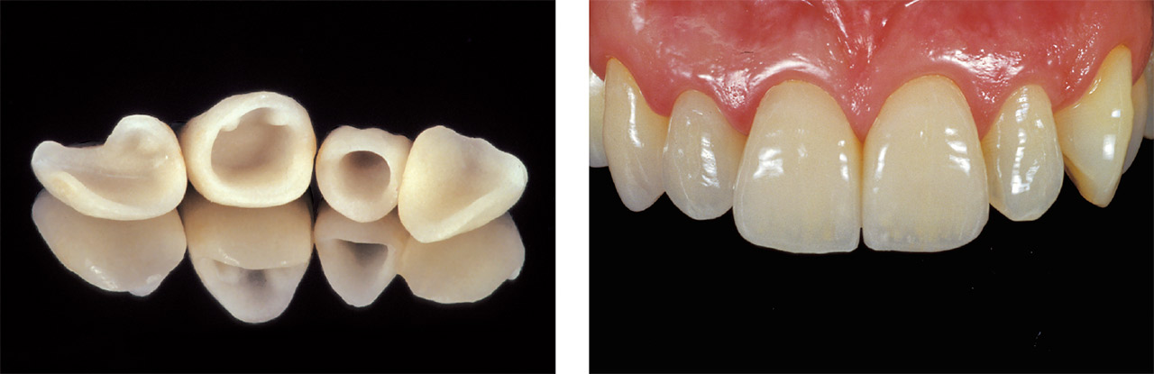 左右中切歯、右側側切歯、犬歯のオールセラミック修復を行う。中切歯、側切歯、犬歯の色調ならびに形態のコントラストを考慮して製作する。すべてのキャラクタライズはインターナルライブステインにより付与されている。＜写真提供：Aki Yoshida 先生＞
