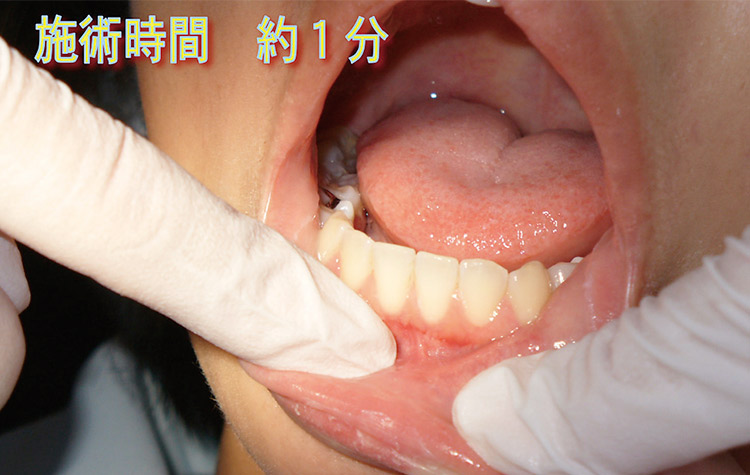 図15 上下口唇を内側からゆっくりマッサージします。前歯部補綴の義歯を使用しないため口唇が内側に引き込まれておられる患者さんは、特に入念に行います。