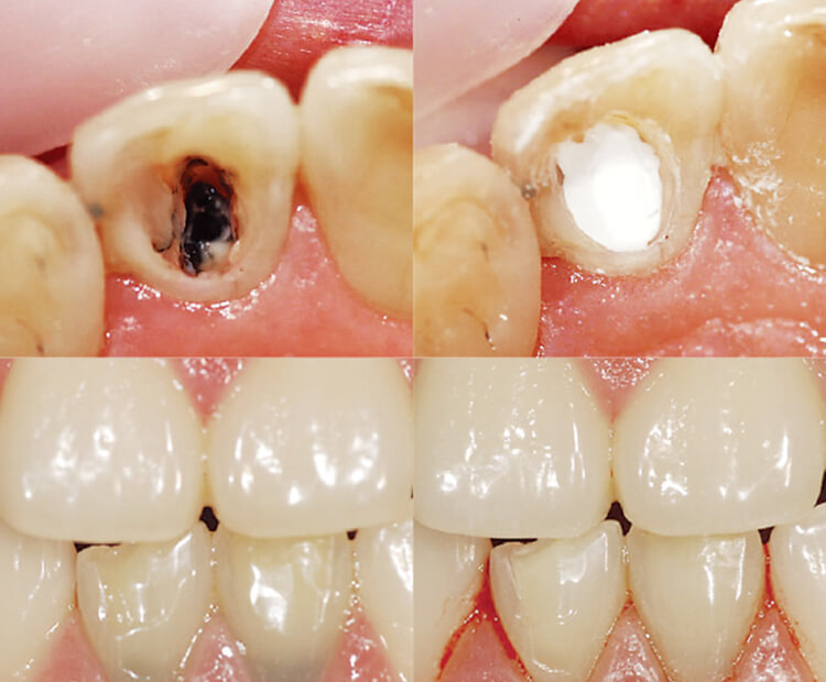 封鎖性と変色防止のために厚いベース材を塗布する。左上：変色した充填材料（暗く変色）。右上：バイオセラミックスで充填後の状態。左下：歯頸部の変色（唇側面観）。右下：バイオセラミックスで充填後（唇側面観）。