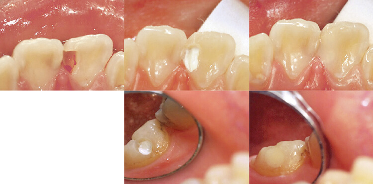 直接覆髄の場合には、白色で変色しないMTAを使用する。<br />上顎左側中切歯舌側近心部への修復症例（左上、中上、右上）。下顎左側第一大臼歯頰側面への修復症例（中下、右下）。