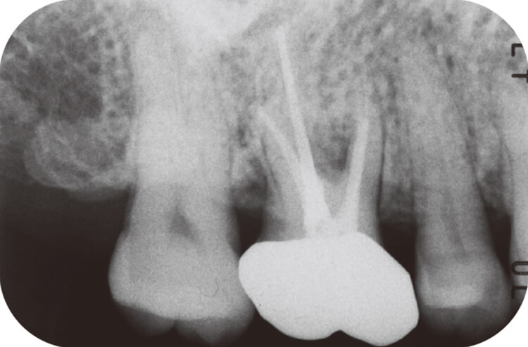2014.12.26 6 デンタルX線写真。根管充填より約2年経過しているが歯周組織に変化は認められない。