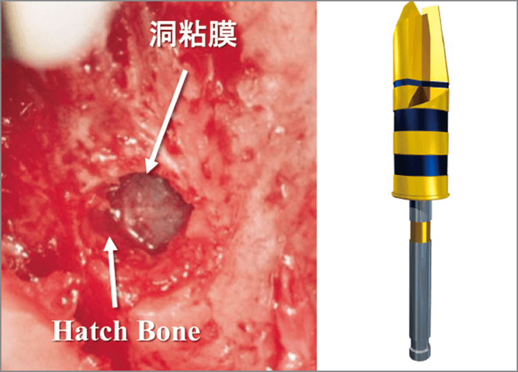 Hatch Reamer®ハッチ状に開洞する。矢印は頰側でハッチ状に開いたHatch Bone。