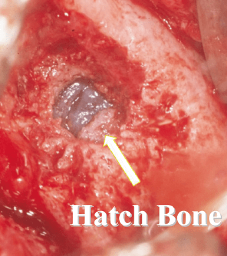 剥離の手順Hatch Reamer®で愛護的に開洞。矢印は遠心部に形成したHatch Bone。