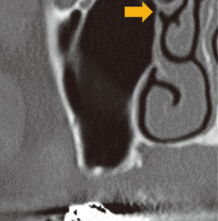 前額断CT。洞内に炎症所見はなく、自然孔は開存し経歯槽頂上顎洞挙上手術の適応である（▶）