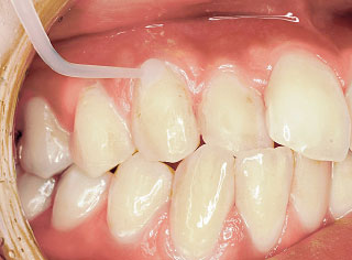 ニードルの先端で歯肉溝内への注入する写真