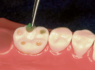 表面処理材グリーンの10秒間擦り塗りによる象牙質表面処理の写真