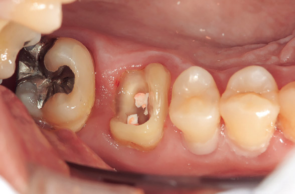 図6 事前に支台歯概形成を行い、歯質の厚みを1mmにて整えると縁上歯質が不十分と思われた。