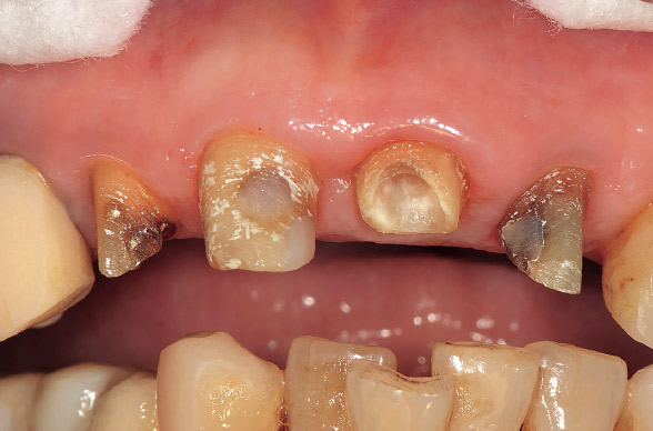 図12 2015年6月12日　縁上歯質概形成時の正面観。歯質量は1mmの高さで3壁残存し、引っ張り側である口蓋側歯質が十分に確保できている。
