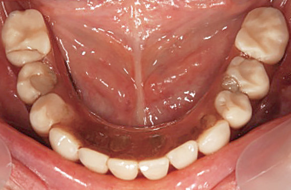 図4 人工歯の経年摩耗