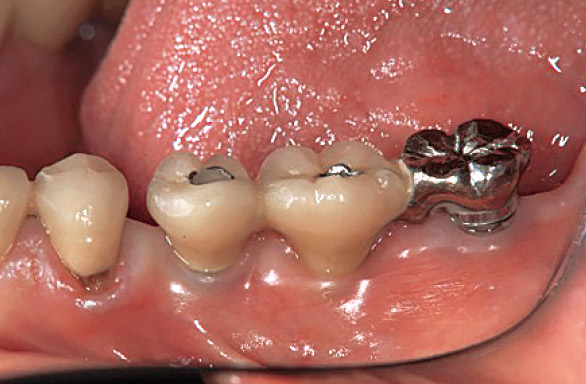 図7 天然歯の近心移動に伴う隣接空隙