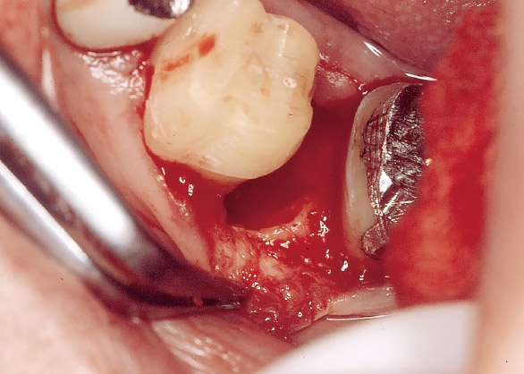 図15 最初の歯周外科（1997年5月）。