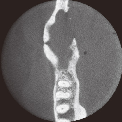 図13b 初診時CBCT水平断。骨破壊が下顎枝内下方へ進展している。