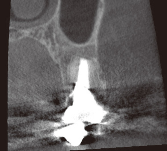 図3 CTによる外科的歯内療法後の25部根尖周囲の状態。