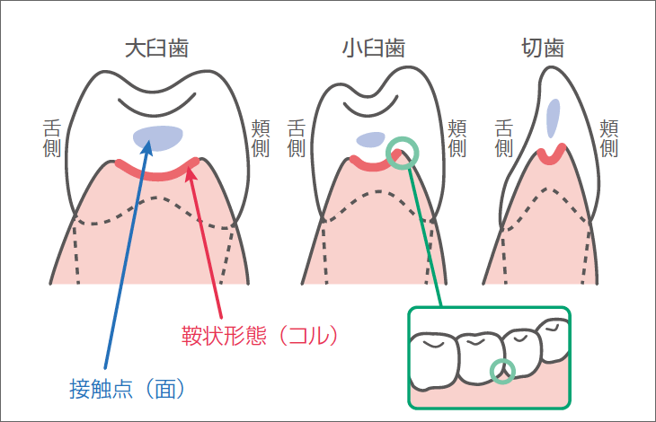 図4 歯間部歯肉の形態