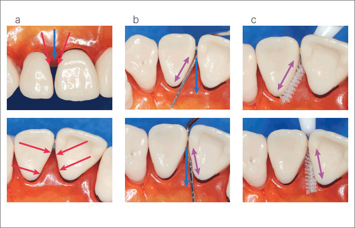 図5 歯根形態と歯間部清掃用具の適用部位