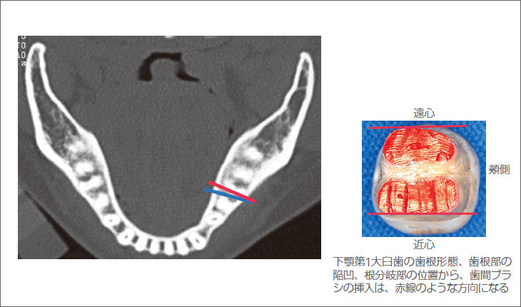 図7 下顎歯頸部の歯根形態と歯間ブラシの挿入方向
