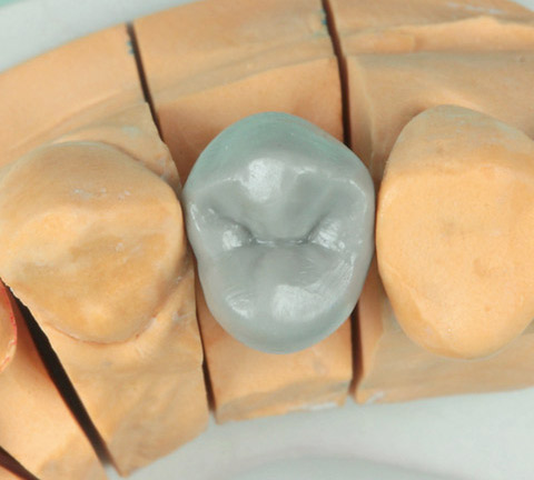 図7 ワックスにて歯冠外形を回復する。