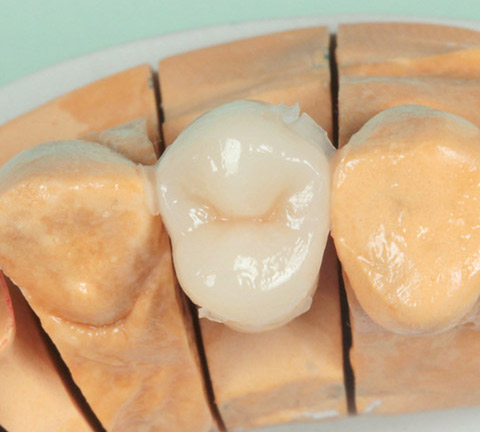 図22 咬合面コアを撤去。歯冠外形を容易に短時間でレジンに置換することができる。