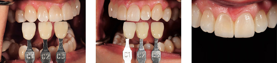 症例2 中切歯2本