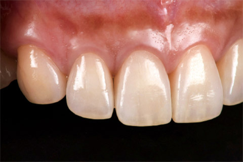 図27 補綴装置装着後2年の前歯部側方面観。歯周組織が維持されている
