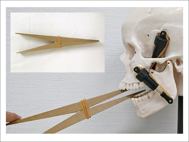 一般的に使用されている開口訓練器は顎関節の蝶番運動を拡大する機能が主となる
