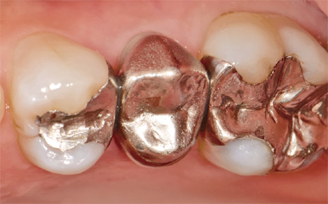 図1 患歯は5 FMCの不適合で、CAD/CAM冠にすることとした。