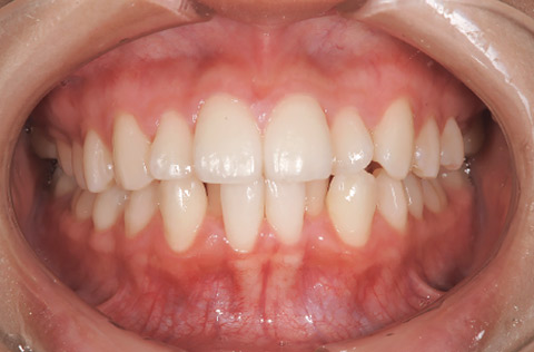 図5 歯列不正患者の口腔内。