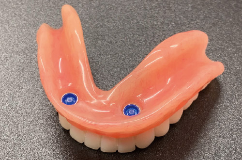 可撤式のロケーター義歯の写真