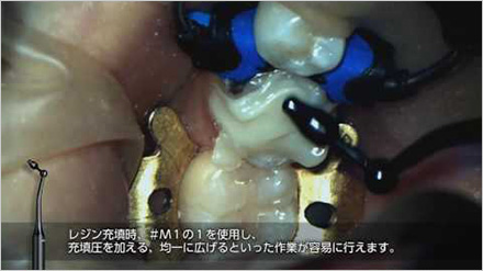 CRマスターを使用した下顎左側2級窩洞のCR充填ムービーのサムネイル