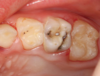 写真1 上顎左側 第一、第二乳臼歯の症例