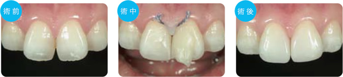 case3 すきっ歯の改善（正中離開） 術前・術中・術後
