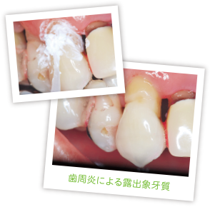 歯周炎による露出象牙質
