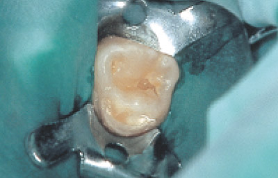 上顎左側第一乳臼歯象牙質碼蝕の写真