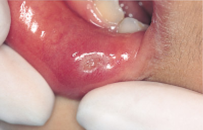 下口唇粘液嚢胞、1週後の写真