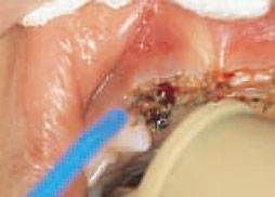 左側切縁部の歯肉を切除する様子