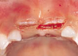 両側歯肉切除直後の状態