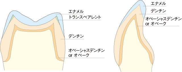 前歯部、臼歯部の基本築盛法の図