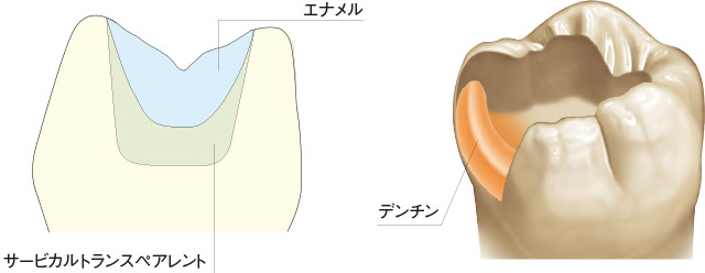 インレーの色調再現法（簡便法）の図