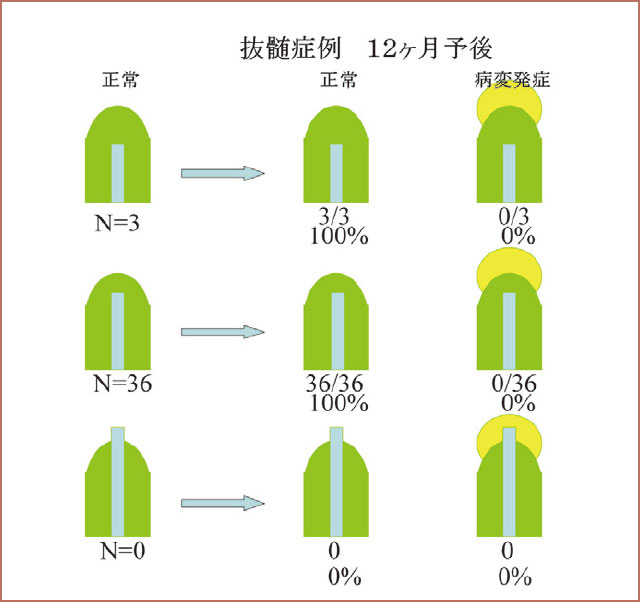 抜髄症例に対するオブチュラⅡ根管充塡12ケ月経過後の根尖歯周組織の変化の図