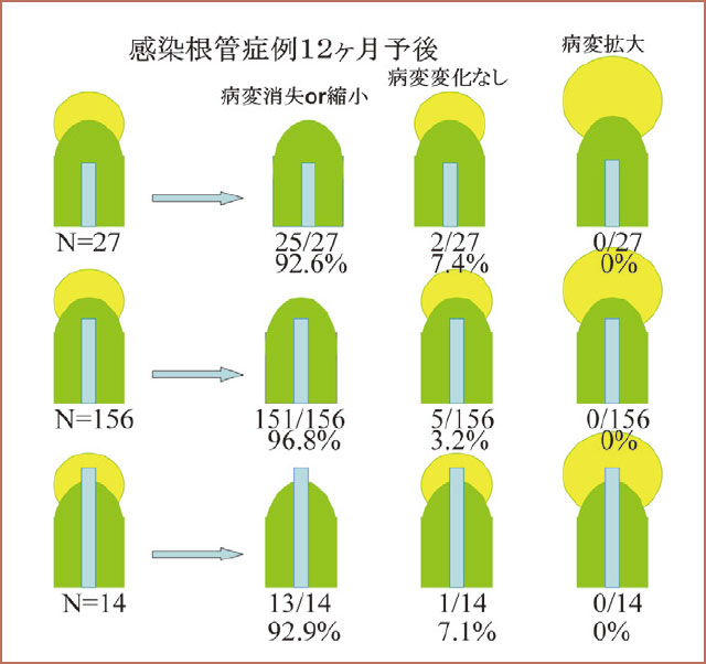 感染根管症例に対するオブチュラⅡ根管充塡12ケ月経過後の根尖歯周組織の変化の図