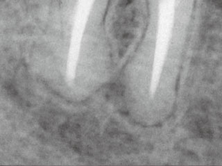 根充後9カ月のX線写真