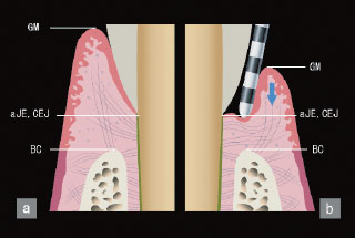 歯肉内側拡大図