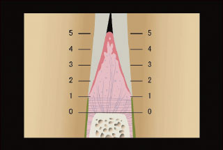 歯間乳頭拡大図
