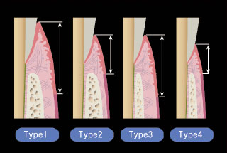 遊離歯肉の比較図