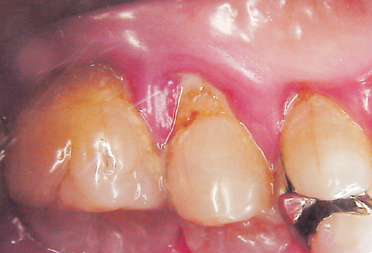症例4 初診時・動揺なし・排膿＋・歯周ポケット5～7mm