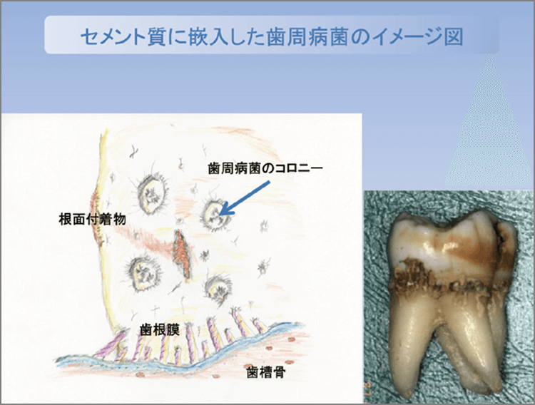 歯槽骨の破壊にともなう歯根膜の喪失は、セメント質表面に様々な影響を与える。一般に言う「粗造なセメント質」という表現は言うまでもなくセメント質に嵌入していた繊維痕であり、エナメル質と違って有機成分が多いことから歯周病菌のコロニーが付着しやすい環境である。